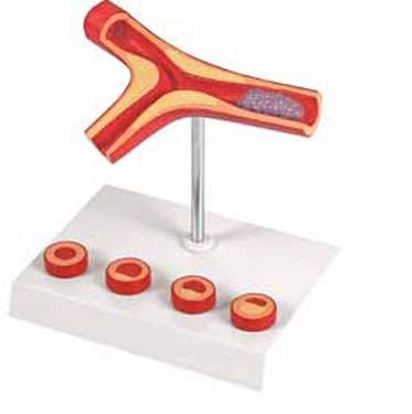 Atherosclerosis and Thrombosis Model